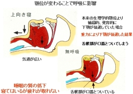 ナイトデンチャー